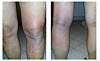 sol allergi symptom sol allergi symptom